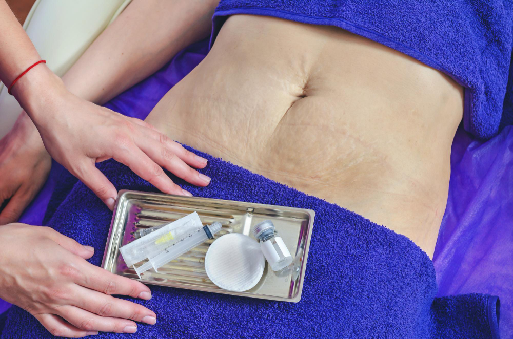 Abdominoplastia: Reconstrucția estetică abdominală